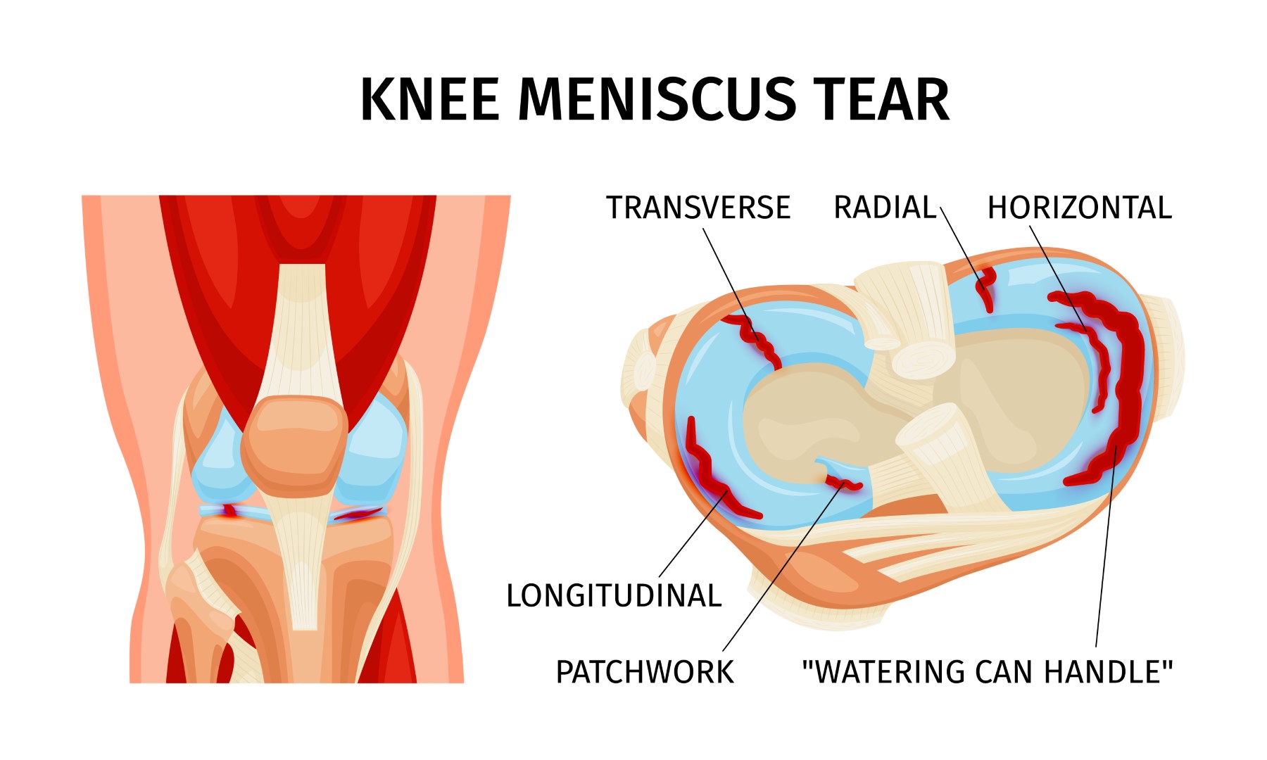 knee_meniscus_tear