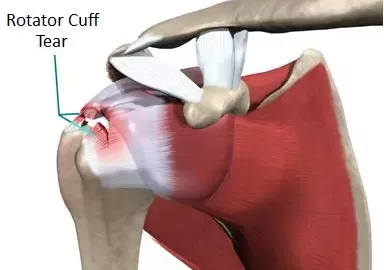 rotator cuff treatment in ahmedabad