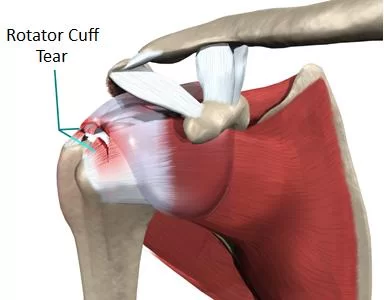 rotator cuff treatment in ahmedabad