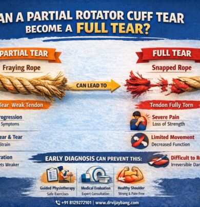 partial rotator cuff treatment in ahmedabad by dr Vijay Bang, shoulder surgeon in ahmedabad, gold medalist, Switzerland trained