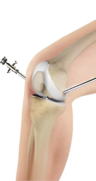 Knee Arthroscopy Surgeon