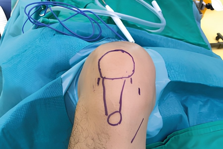 Minimally Invasive Knee Surgery