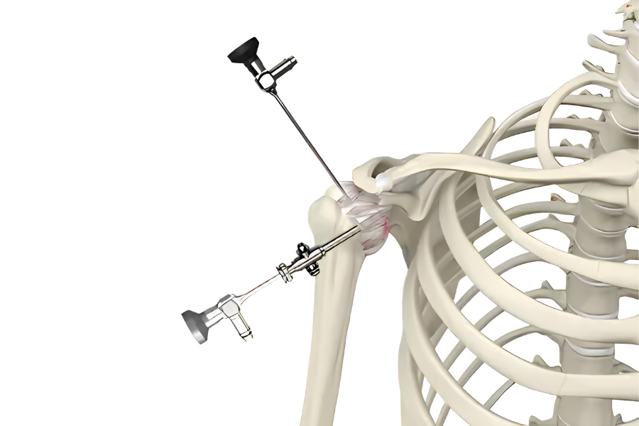 Dr. Vijay Bang consultation for shoulder arthroscopy